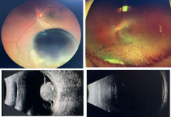 以為只是眼花，竟查出眼內(nèi)惡性腫瘤！50歲男子及時(shí)就醫(yī)后，獲“保眼”治療機(jī)會(huì)！