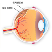 揉眼睛時(shí)出現(xiàn)閃光感是怎么回事？注意！可能是視網(wǎng)膜脫離！